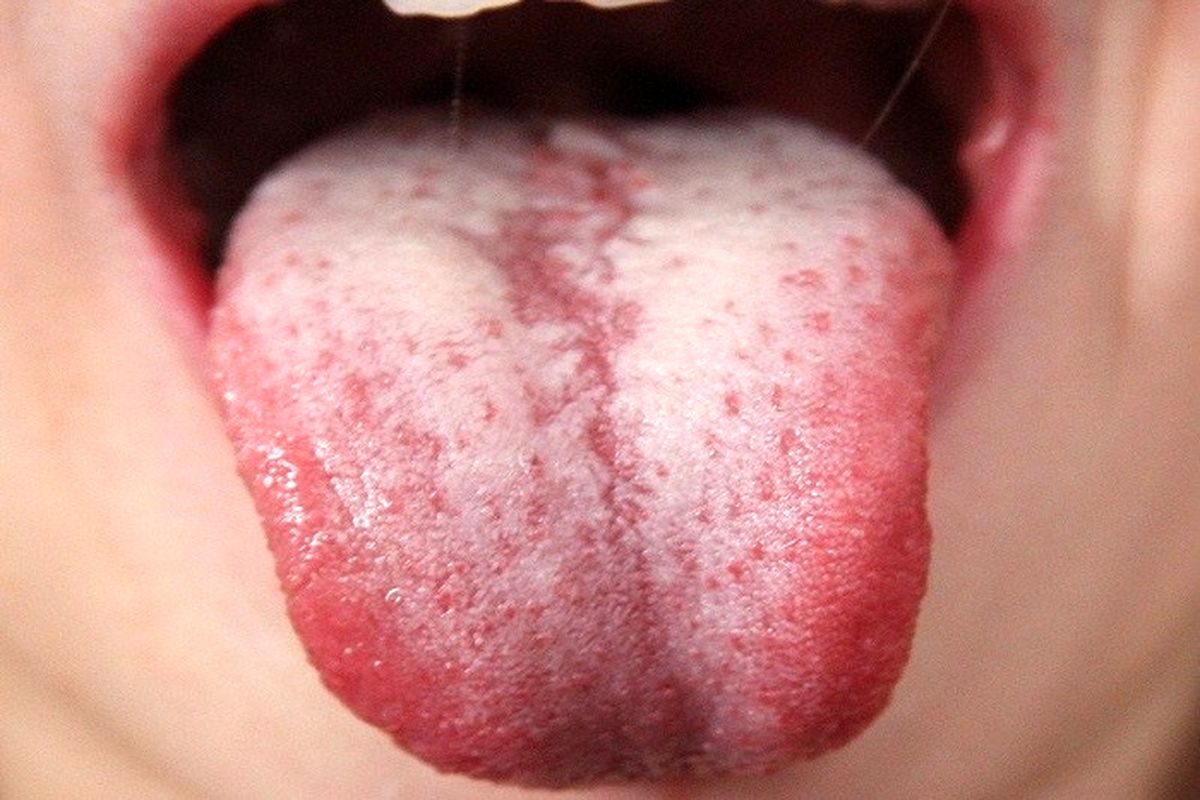 سفید شدن زبان نشان دهنده این بیماری است!